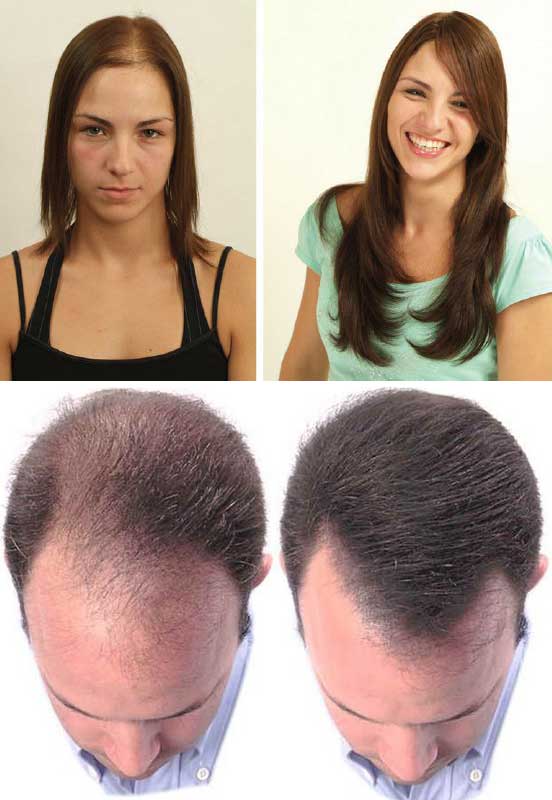 Волосы выпадают короткими. Стрижки при облысении у женщин. Прическа для выпадающих волос. Волосы при алопеции стрижки для женщин.